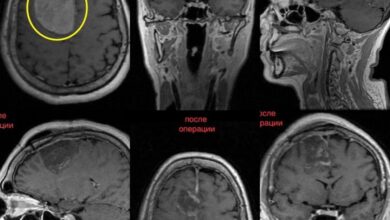 Photo of В Одинцово спасли пациентку, удалив менингиому головного мозга размером с куриное яйцо